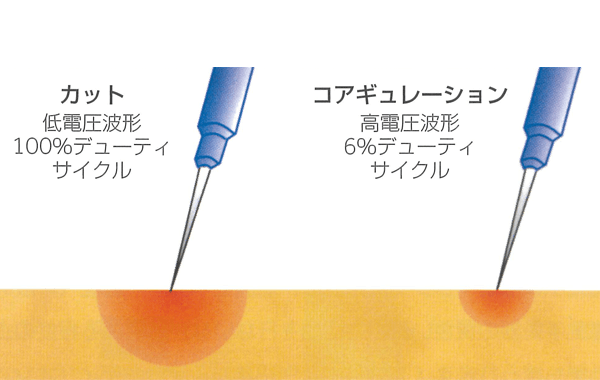 電気外科手術スタディガイド 図11