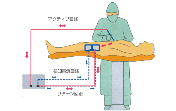 電気外科手術スタディガイド 図19