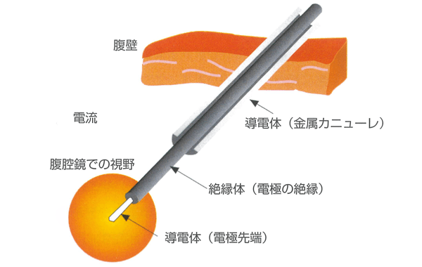 電気外科手術スタディガイド 図27